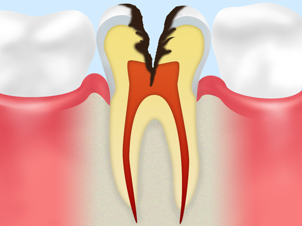 C3【歯の神経に達した虫歯】