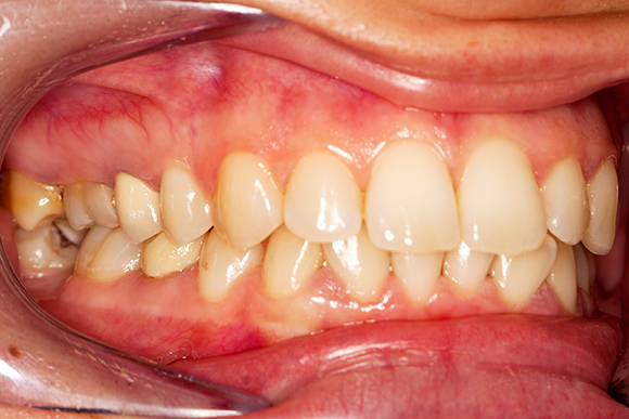 歯周病は全身に影響をおよぼすこわい病気です
