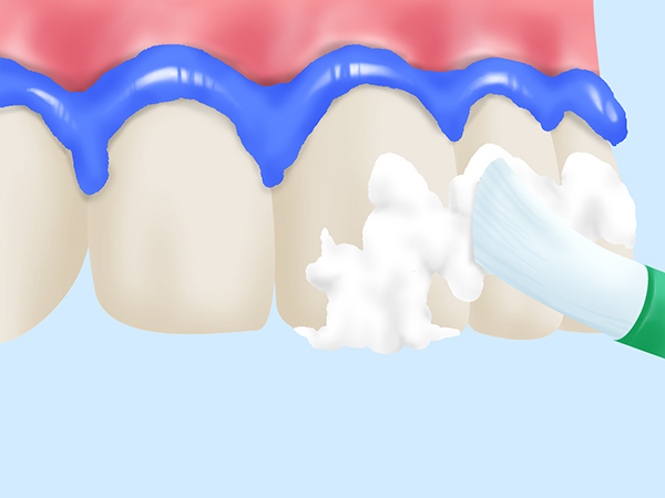 Step3：歯肉保護とホワイトニング剤の塗布